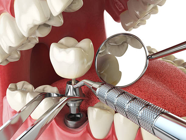 Best Emergency Root Canal Therapy in Leitchfield, KY